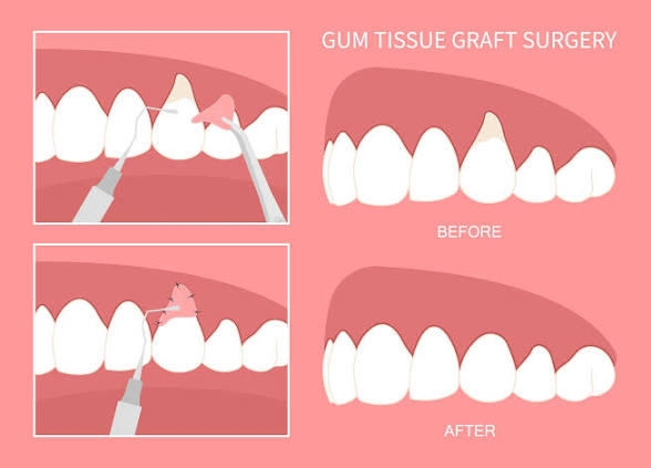 Gum Surgery