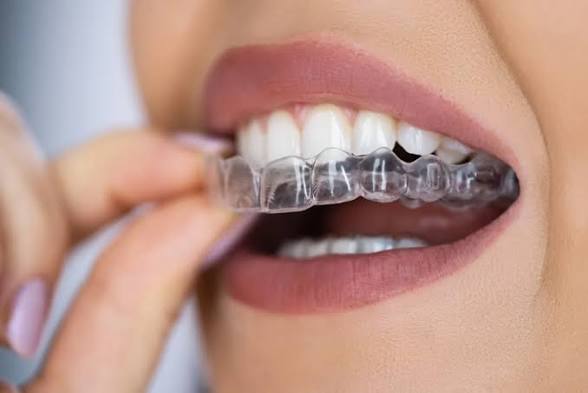 Aligner