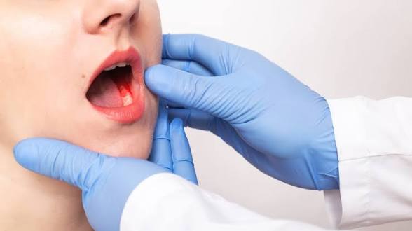 Oral Cancer