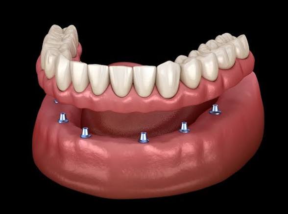 Complete Denture