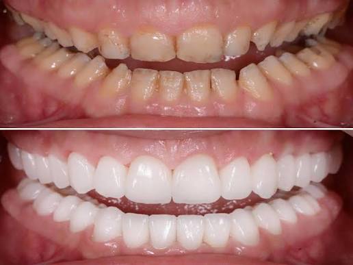 Full Mouth Rehab